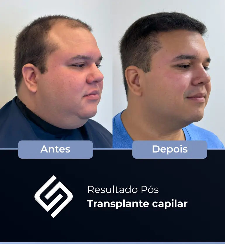 SN - antes e depois tc 10