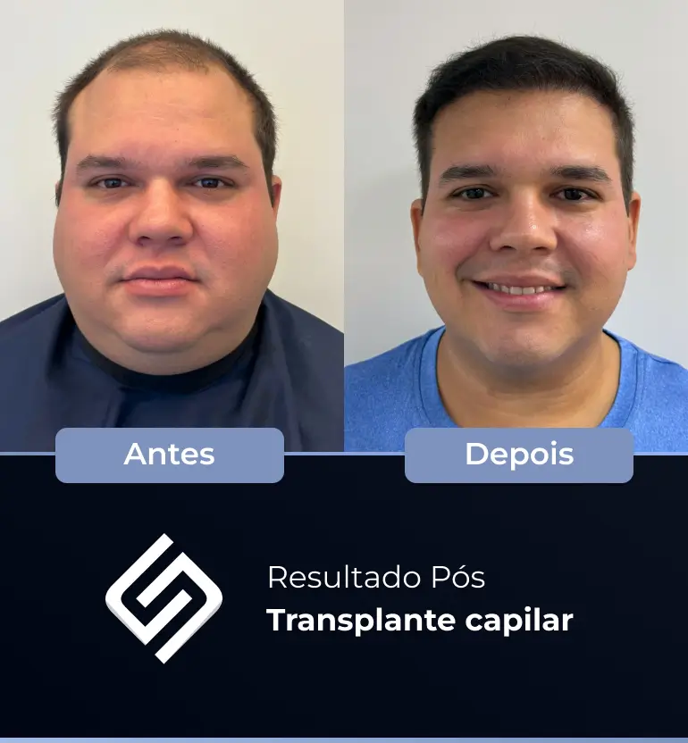 SN - antes e depois tc 11