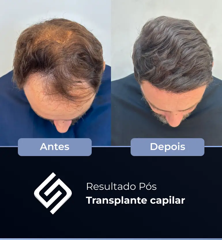 SN - antes e depois tc 13