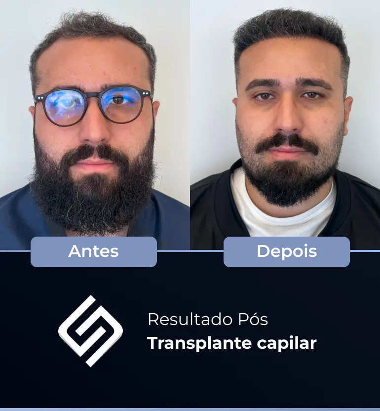 SN - antes e depois tc 15