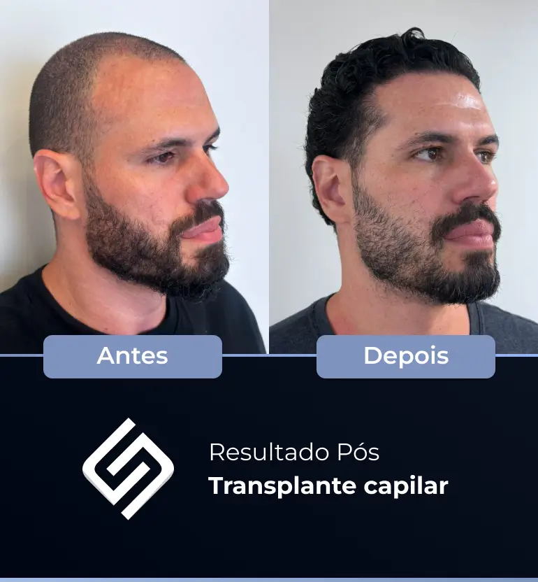 SN - antes e depois tc 16