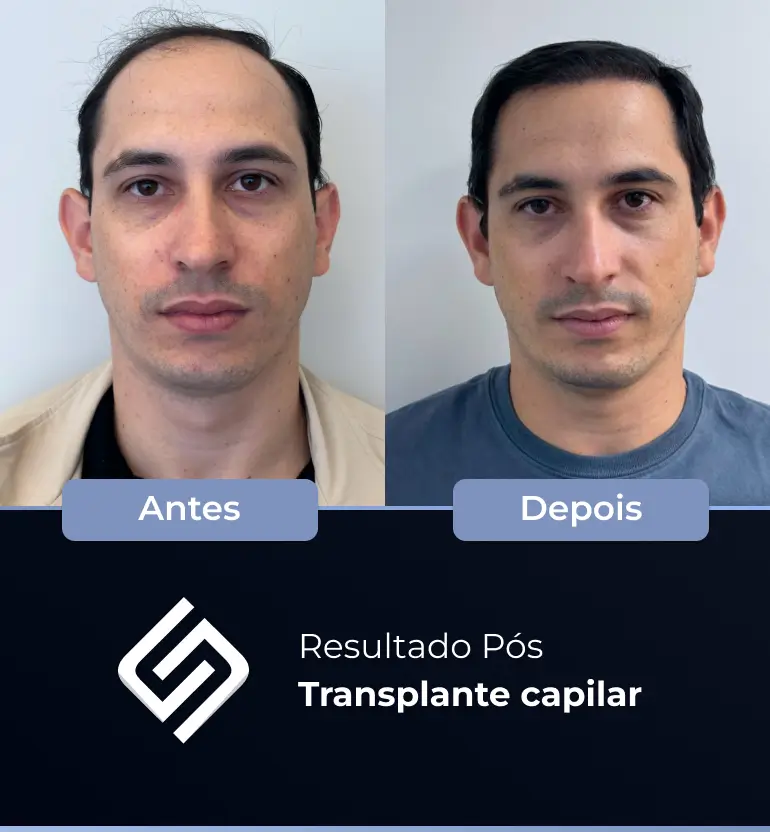 SN - antes e depois tc 17
