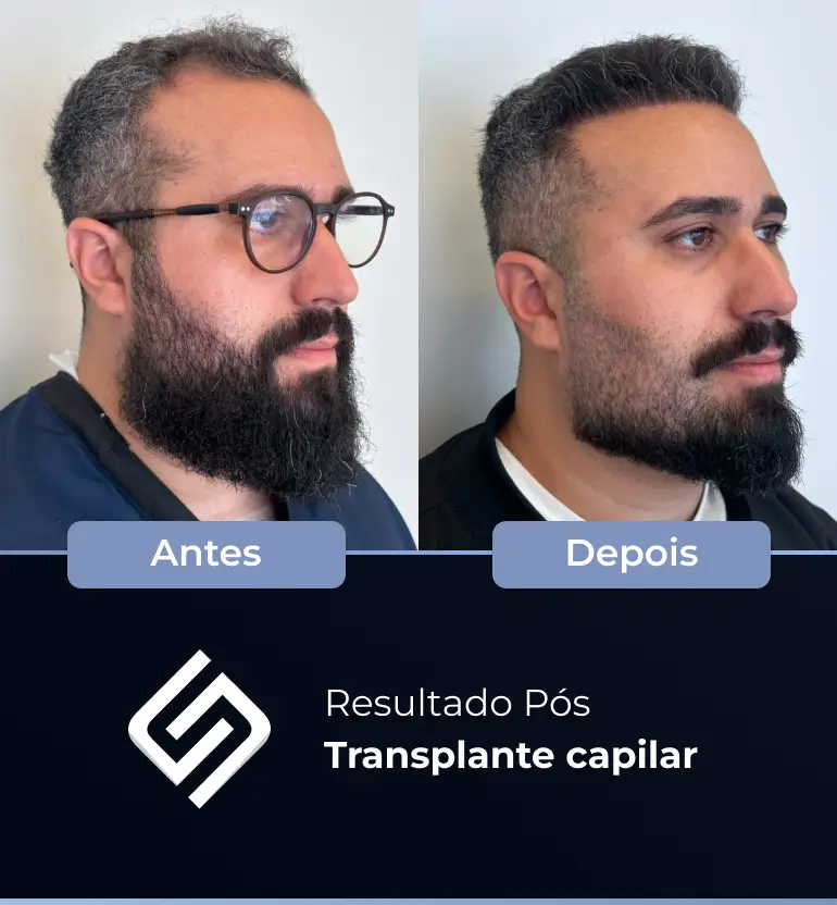 SN - antes e depois tc 18