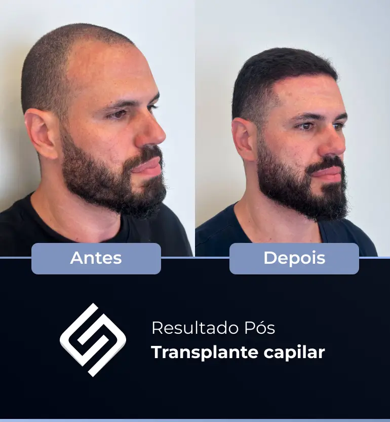 SN - antes e depois tc 2