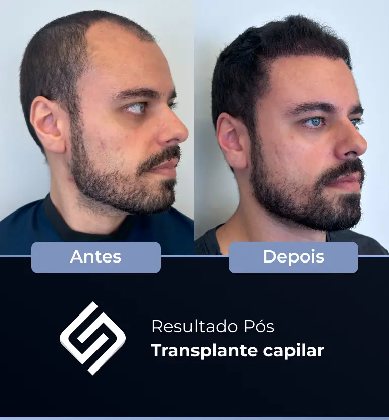 SN - antes e depois tc 4