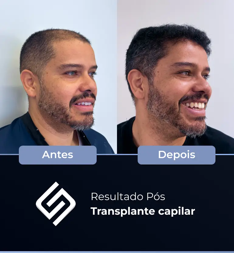 SN - antes e depois tc 6