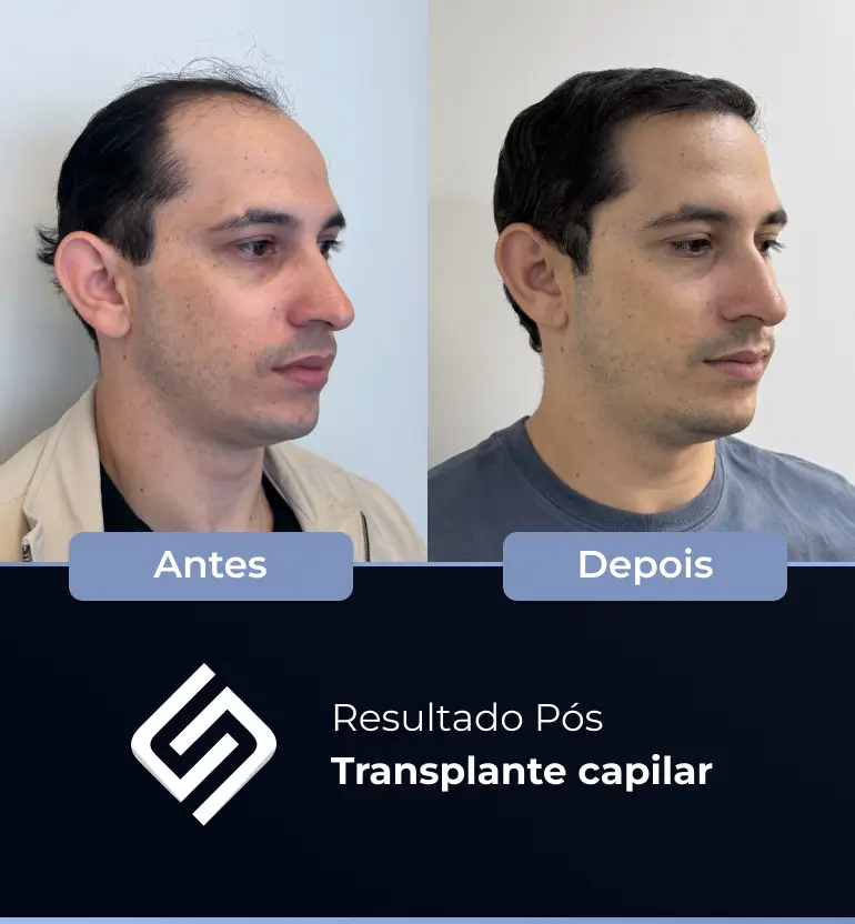 SN - antes e depois tc 7